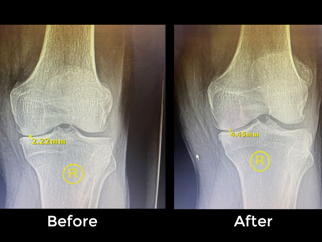 Knee Pain Treatment by Dr. Pete Strombeck