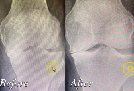 Photo of Before and after treatment by Granite Bay Advanced Joint Pain Relief Solutions