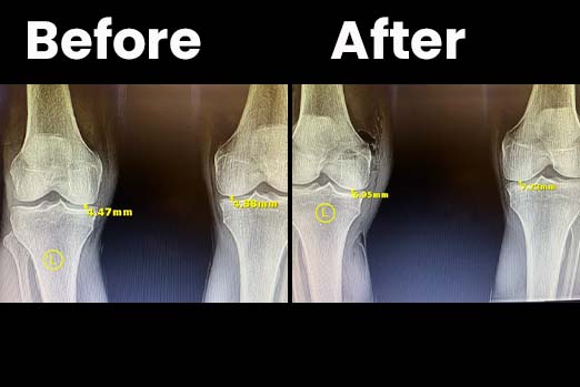 Ankle Pain Treatment by Dr. Pete Strombeck