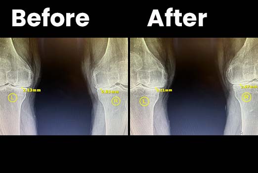 Knee Pain Treatment by Dr. Pete Strombeck
